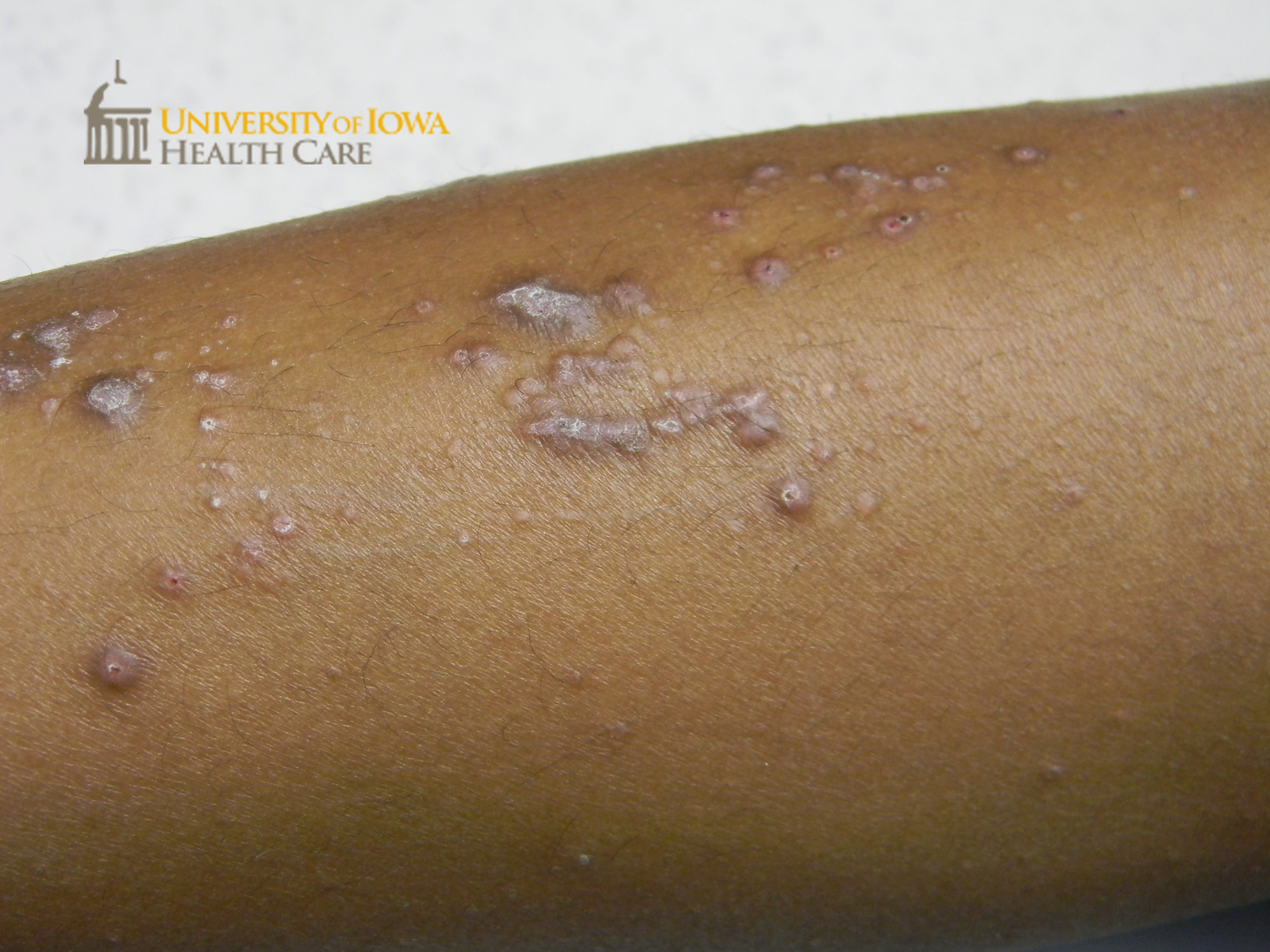 Pink to violaceous polygonal papules with overlying white scale coalesing into plaques on the lower leg. (click images for higher resolution).